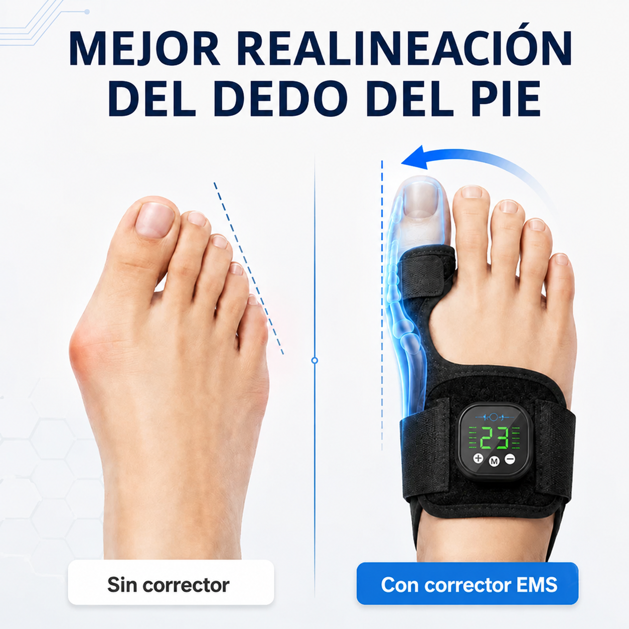 AEXZR® Nexalign Pro — Corrector de juanete EMS