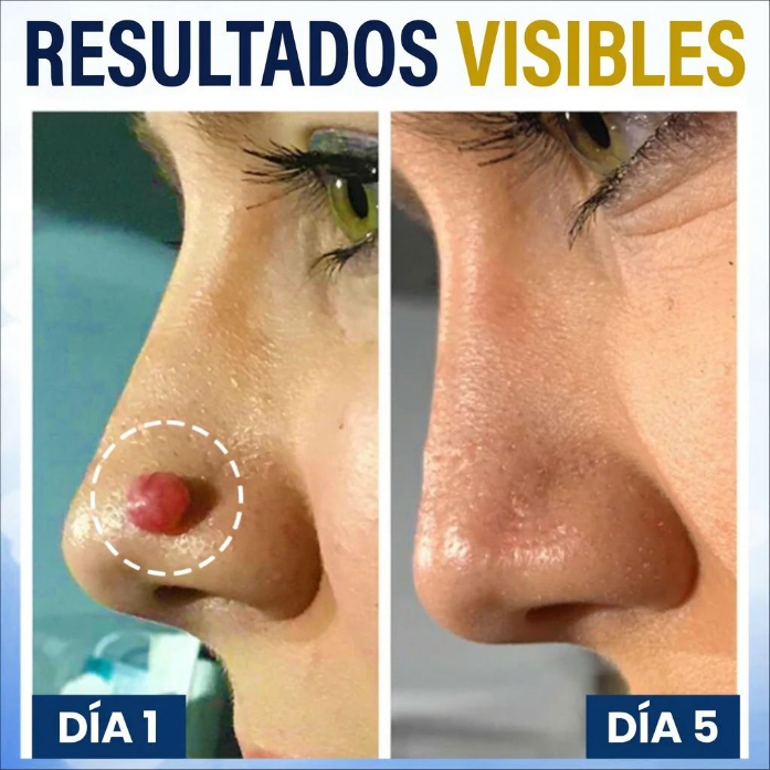🏆 Crioterapia Profesional en Casa | AEXZR® Skin Tag Spray Criogénico：Eliminación rápida y sin dolor de verrugas y córneas ✨