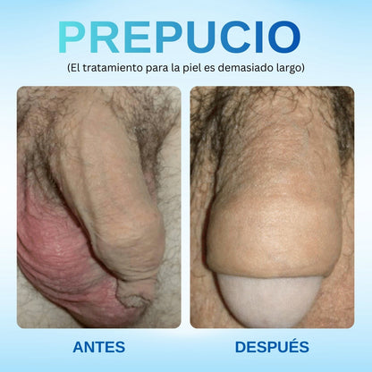 🚀 Seguro para piel sensible & sin irritación:RZXEA™ Gel Corrector de Prepucio Redundante